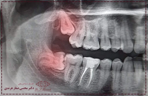 جراحی دندان عقل نهفته 