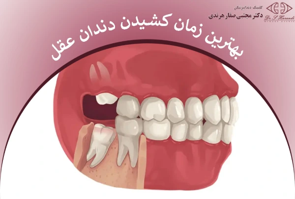 بهترین زمان کشیدن دندان عقل