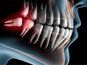 بهترین زمان کشیدن دندان عقل