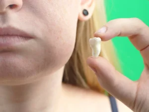 ورم صورت بعد از جراحی دندان عقل