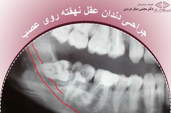 دندان عقل نهفته روی عصب
