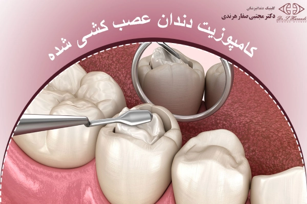 کامپوزیت دندان عصب کشی شده