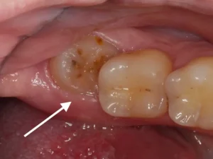 جراحی دندان عقل نیمه نهفته