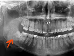 دندان عقل نهفته روی عصب