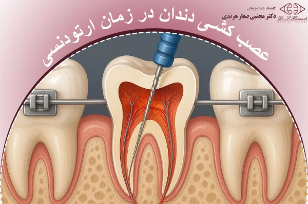 عصب کشی دندان ارتودنسی شده