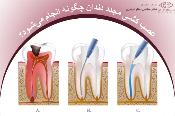 عصب کشی مجدد دندان چگونه انجام میشود؟