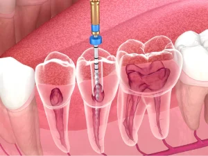 هزینه عصب کشی دندان چقدر است؟