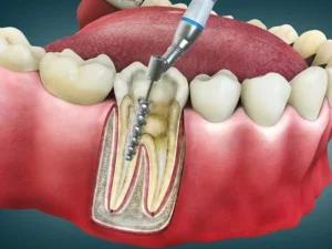 عصب کشی مجدد دندان