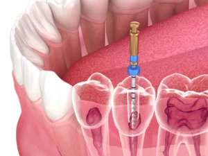 عصب کشی یا درمان ریشه دندان چیست؟