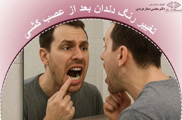 تغییر رنگ دندان بعد از عصب کشی