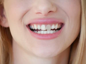 بلیچینگ دندان عصب کشی شده