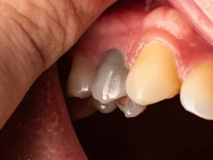 دلیل تغییر رنگ دندان بعد از عصب کشی