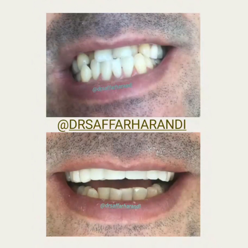 کامپوزیت برای دندان های کج