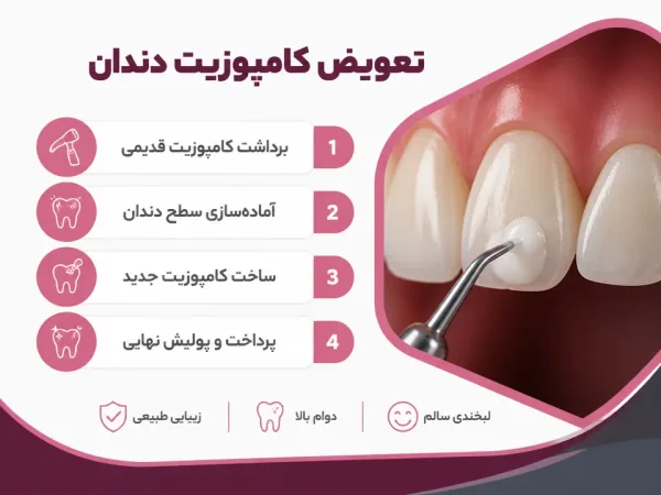ساخت و پرداخت کامپوزیت جدید — مراحل برداشت کامپوزیت قدیمی و قرار دادن کامپوزیت جدید